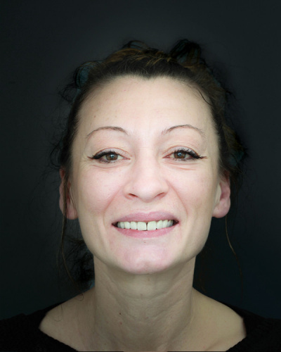 Katiuscia - Cirkularni most -gornja čeljusti, implantoprotetska sanacija donje čeljusti