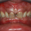 Katiuscia - Kreisförmige Dental Brücke – Oberkiefer, Prothetische Implantat Sanierung – Unterkiefer