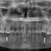 Katiuscia - Circular bridge - upper jaw, Implant prosthetics jaw repair - lower jaw