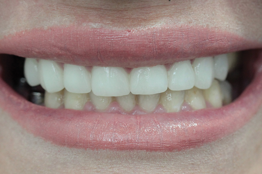 Maja - Gornja čeljust- bočni most na implantatima, donja čeljust- implantoprotetska sanacija čeljusti