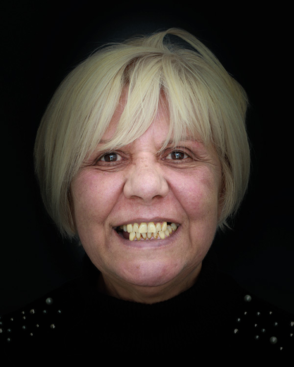 Dorothea - Implantoprotetska sanacija čeljusti