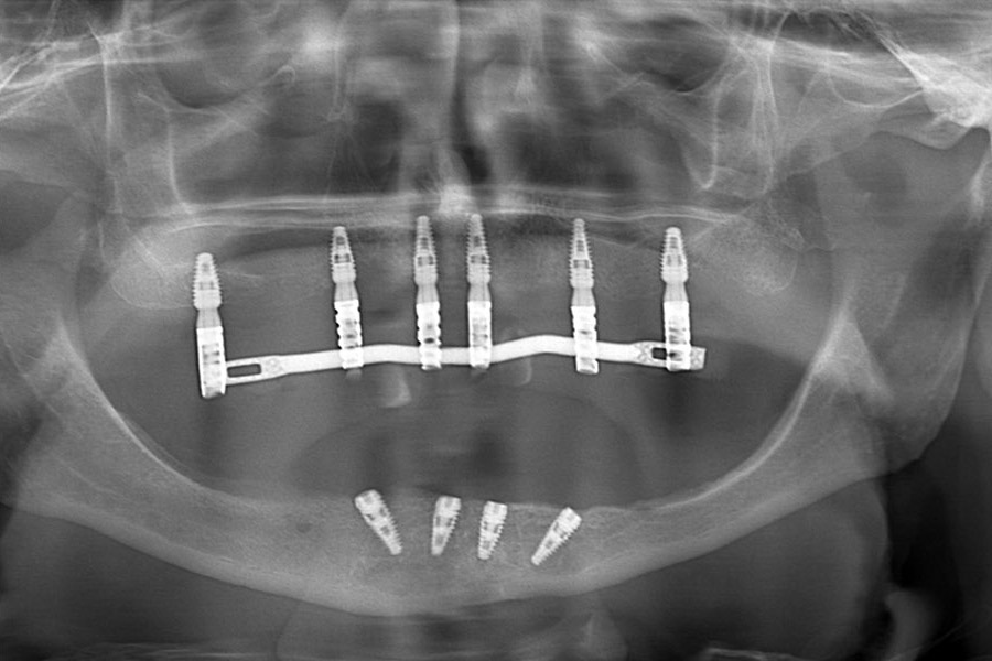 Marco - All on 6 - upper jaw, crossbar implants - lower jav