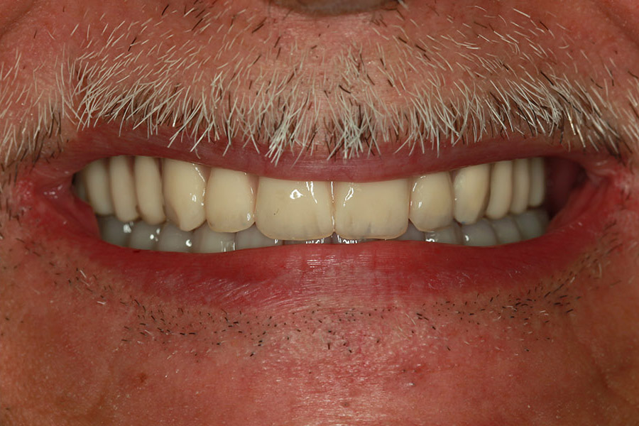 Marco - All on 6 - upper jaw, crossbar implants - lower jav
