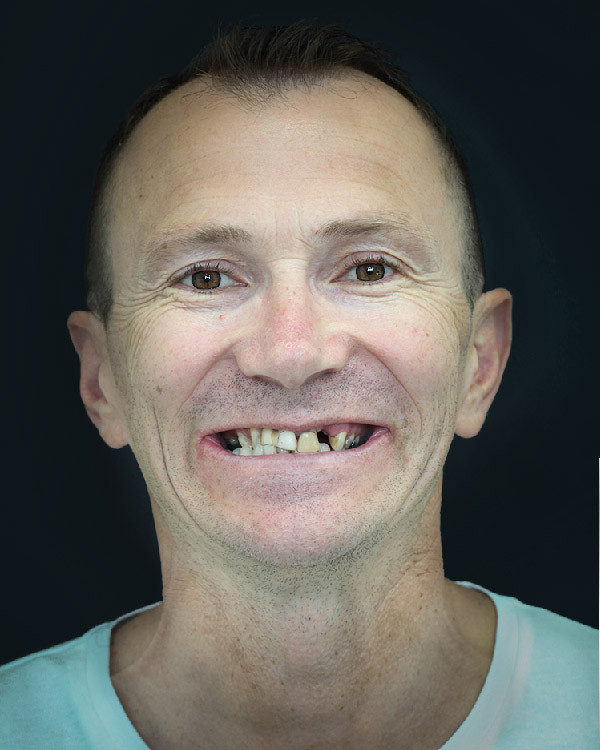 Darko - Prosthetic repair off upper and lower jaw