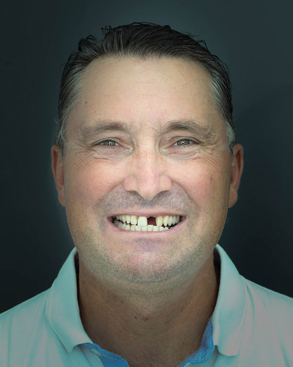 Boško - Implantation of a single tooth, teeth whitening