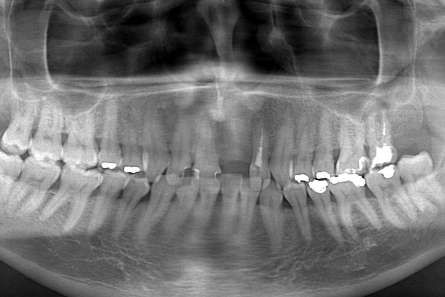 Boško - Sostituzione 1 dente , depigmentazione della gengiva e sbiancamento dei denti