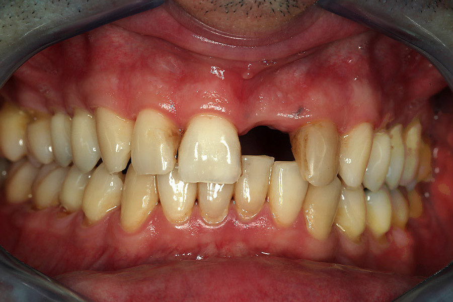 Boško - Sostituzione 1 dente , depigmentazione della gengiva e sbiancamento dei denti