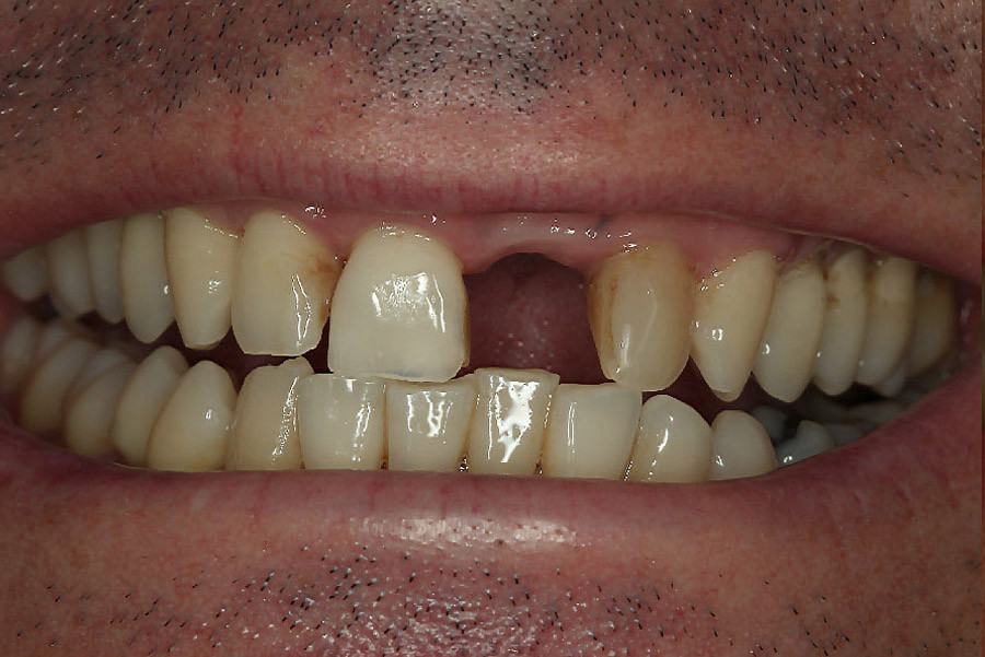 Boško - 1 Zahnersatz, Depigmentierung der Gingva und Zahnaufhellung
