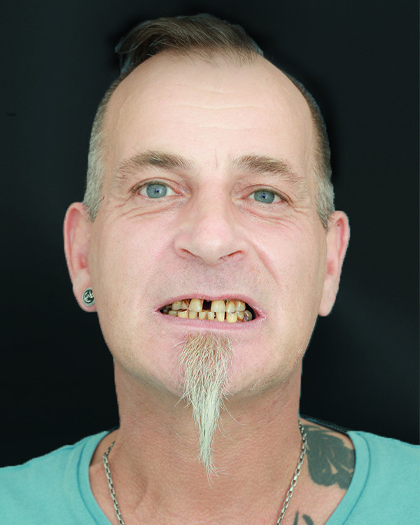 Ralf - All on 4 -upper and lower jaw