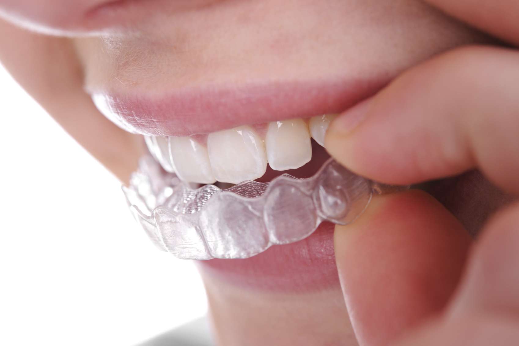 Invisalign aparatić u ortodonciji djece